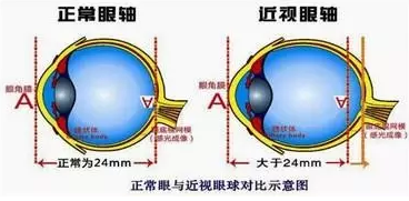 近視眼球突出？！控制近視度數加深是關鍵！