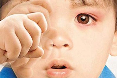 秋季紅眼病高發(fā)，當(dāng)心孩子被傳染