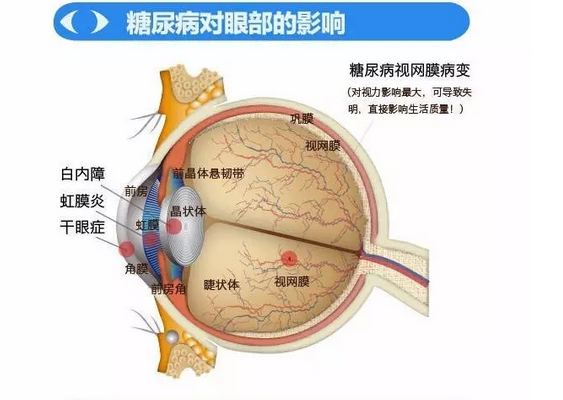 你造嗎？糖尿病晚期眼睛會(huì)致盲！