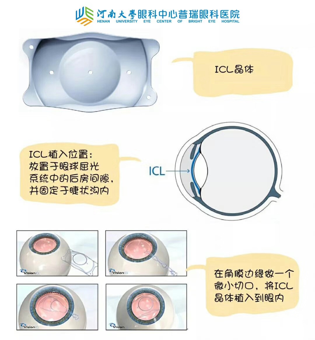 近視度數(shù)太高，還能做手術嗎？