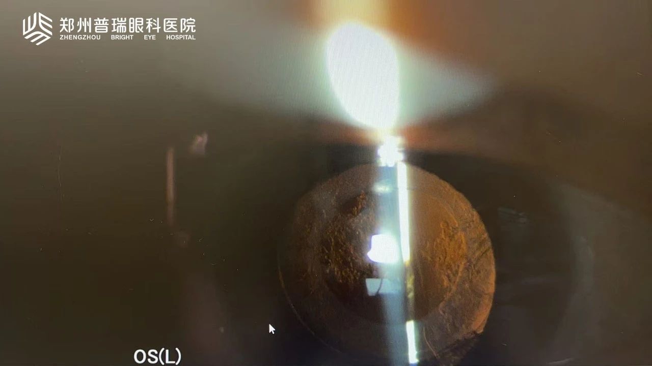 白內障術后視力又下降？6大原因多方面解析！